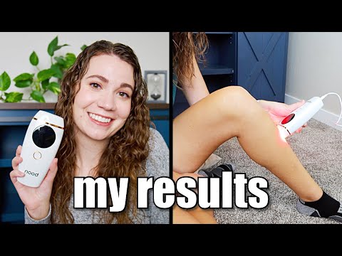 MY RESULTS | Nood The Flasher 2.0 | at home IPL hair removal